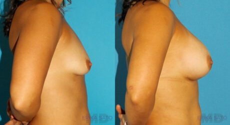 Breast Augmentation case #5632
