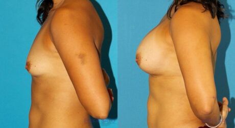Breast Augmentation case #5614