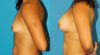 Breast Augmentation case #5632 slider thumbnail