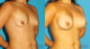 Breast Augmentation case #5614 slider thumbnail