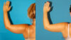 Liposuction case #5893 slider thumbnail