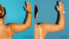 Liposuction case #5893 slider thumbnail