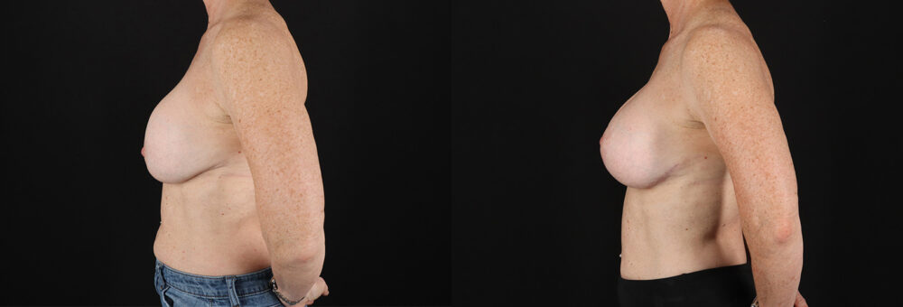 Revision Breast Surgery case #256267