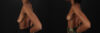 Breast Lift case #7806 slider thumbnail
