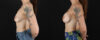 Breast Augmentation case #6491 slider thumbnail