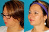 Submental Liposuction case #6945 slider thumbnail