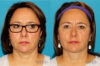 Submental Liposuction case #6945 slider thumbnail