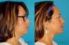 Submental Liposuction case #6945 slider thumbnail