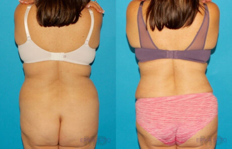 Tummy Tuck case #7171