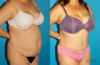 Tummy Tuck case #7171 slider thumbnail