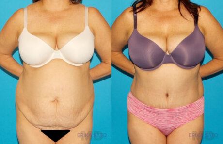 Tummy Tuck case #7171