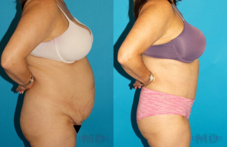 Tummy Tuck case #7171