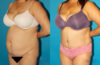 Tummy Tuck case #7171 slider thumbnail