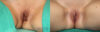 Labiaplasty case #5540 slider thumbnail