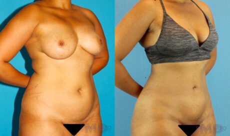 Liposuction case #5892