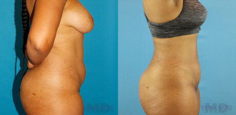 Liposuction case #5892