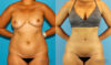 Liposuction case #5892 slider thumbnail