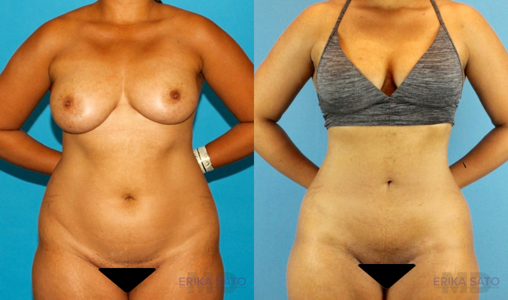Liposuction case #5892
