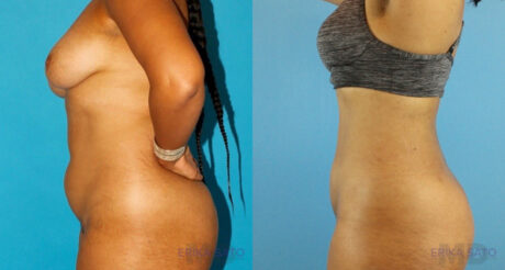 Liposuction case #5892