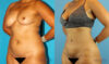 Liposuction case #5892 slider thumbnail