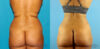 Liposuction case #5892 slider thumbnail