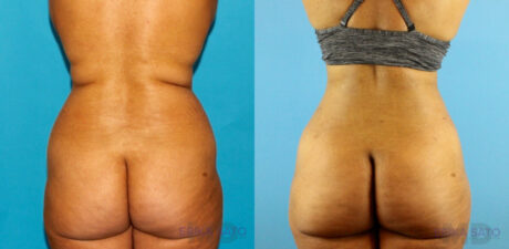 Liposuction case #5892