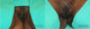 Labiaplasty case #5537 slider thumbnail