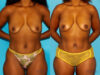 Fat Grafting to the Breast case #256147 slider thumbnail