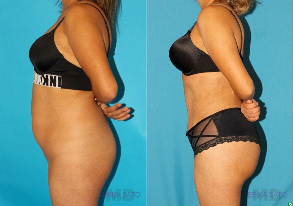 Brazilian Butt Lift case #4819