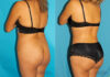 Brazilian Butt Lift case #4819 slider thumbnail