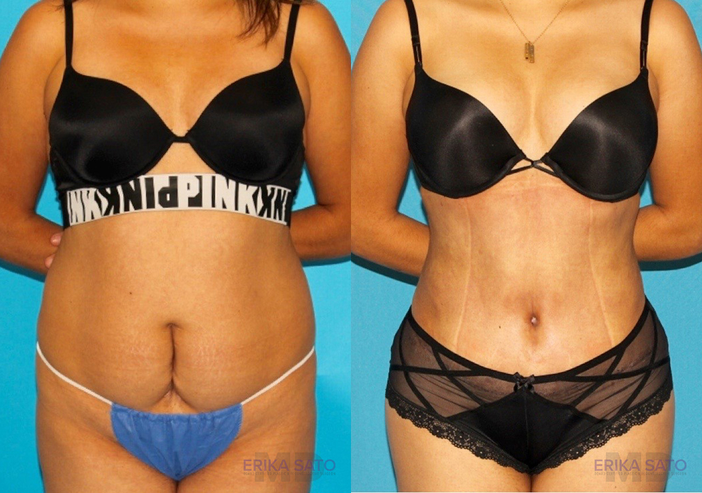 Brazilian Butt Lift case #4819
