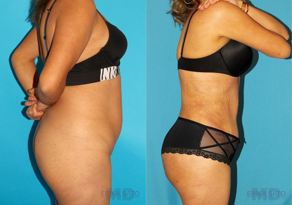Brazilian Butt Lift case #4819