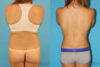 Liposuction case #5883 slider thumbnail