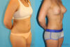 Liposuction case #5883 slider thumbnail