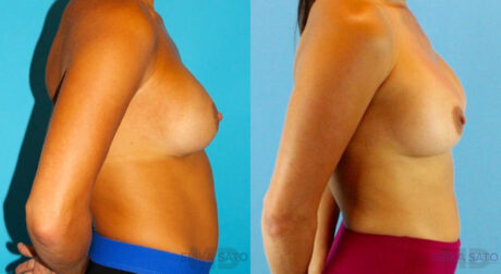 Revision Breast Surgery case #256254