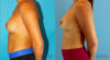 Revision Breast Surgery case #256254 slider thumbnail