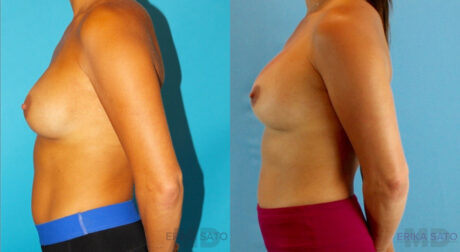 Revision Breast Surgery case #256254