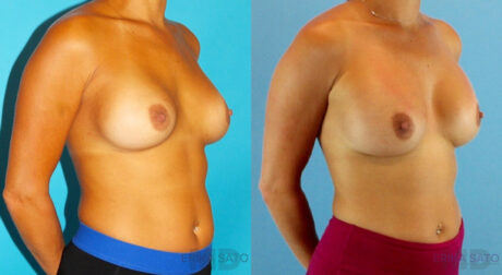 Revision Breast Surgery case #256254