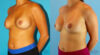 Revision Breast Surgery case #256254 slider thumbnail
