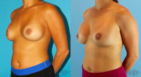 Revision Breast Surgery case #256254