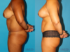 Mommy Makeover case #6507 slider thumbnail