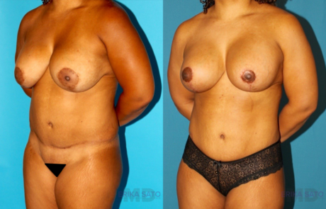 Mommy Makeover case #6507