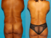 Mommy Makeover case #6507 slider thumbnail