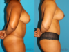 Mommy Makeover case #6507 slider thumbnail