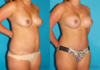 Mommy Makeover case #6508 slider thumbnail