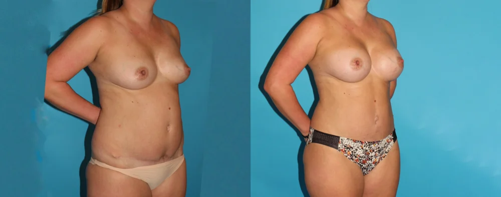 Mommy Makeover case #6508