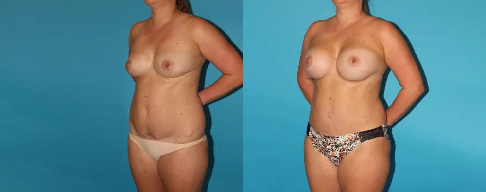 Mommy Makeover case #6508
