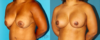 Revision Breast Surgery case #7878 slider thumbnail