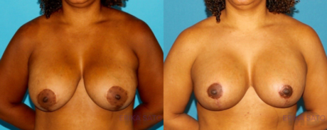 Revision Breast Surgery case #7878