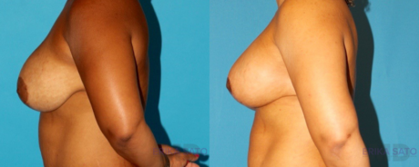 Revision Breast Surgery case #7878